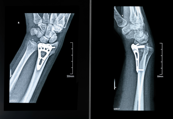 Internal Fixation Surgery After a Car Accident